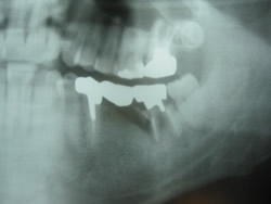 負担過重による右下７の歯根破折